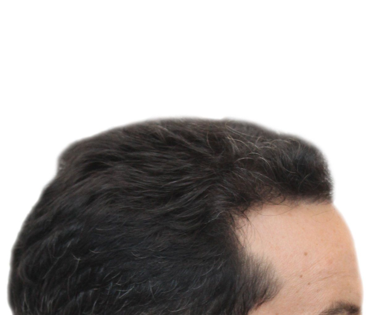 Hair transplant recipient; dark hair, receding hairline.