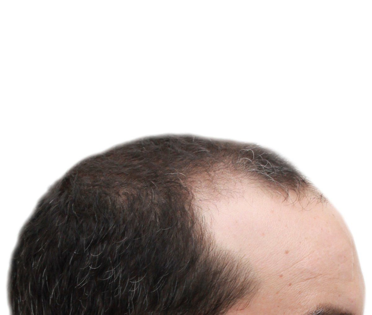 Man with receding hairline, showing thinning hair on the crown of his head.