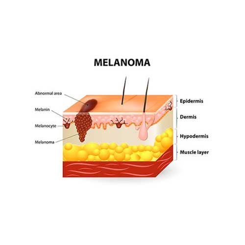 Melanoma — Aurora, CO — The Sun Bus