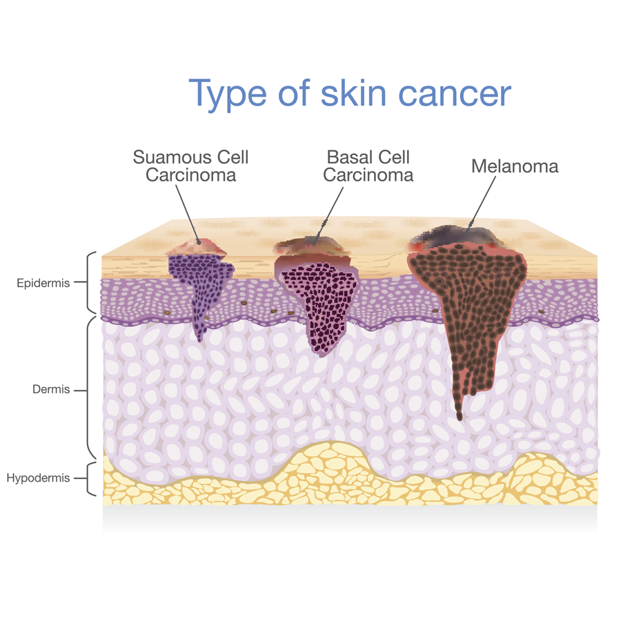 Types of Skin Cancer Types of Skin Cancer