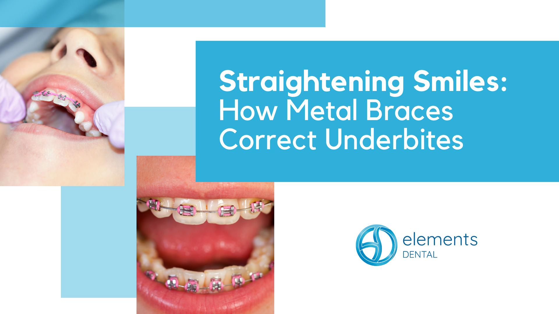 A picture of a person with metal braces on their teeth