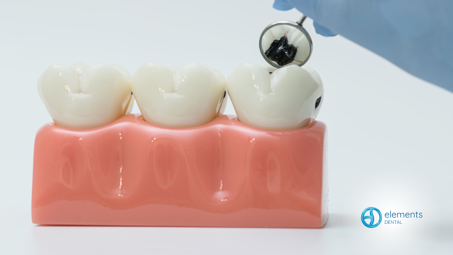 Dental model with pink gums and three white teeth, one tooth fitted with a metal bracket and wire