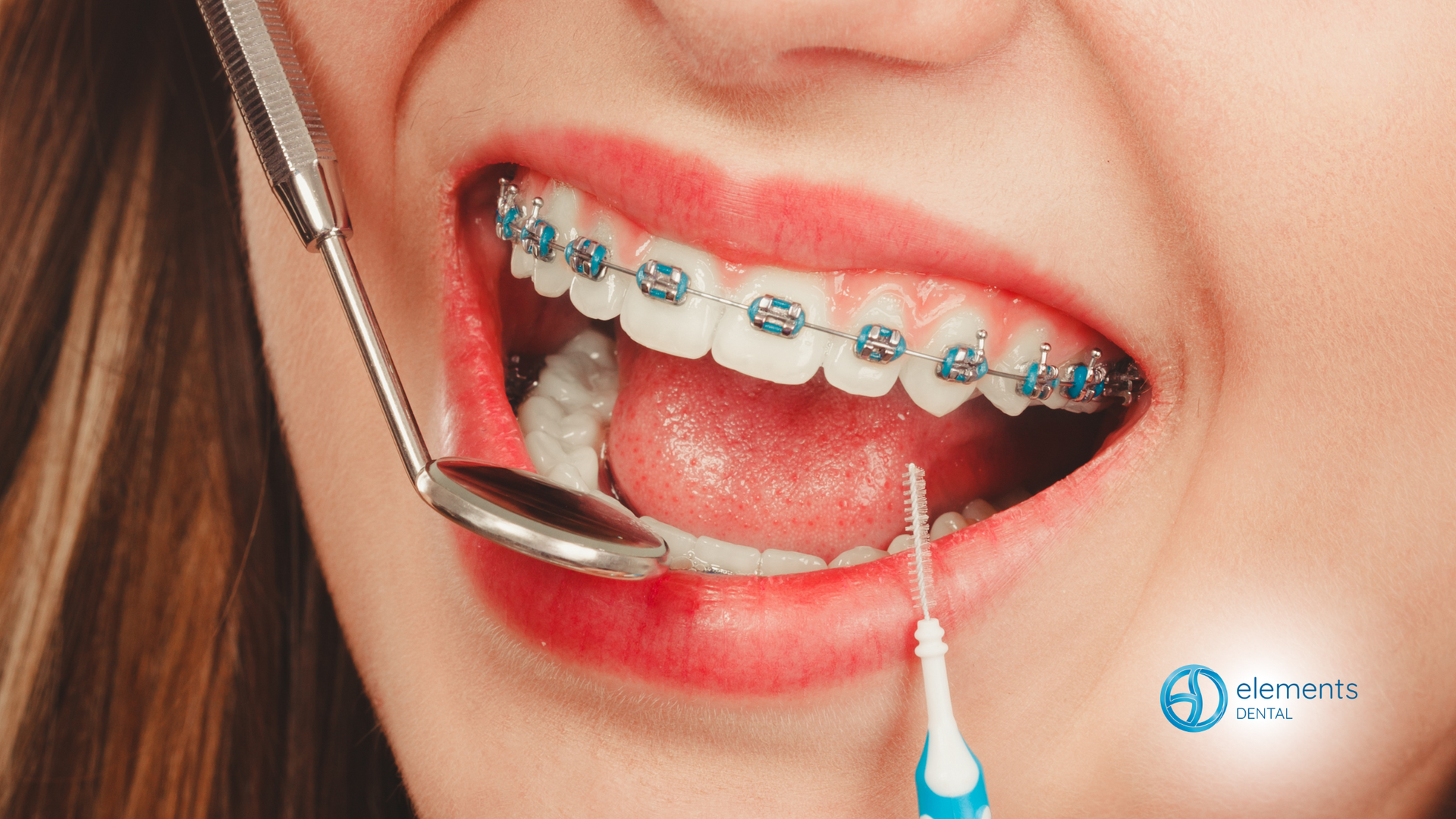 A woman with braces is brushing her teeth with an interdental brush.