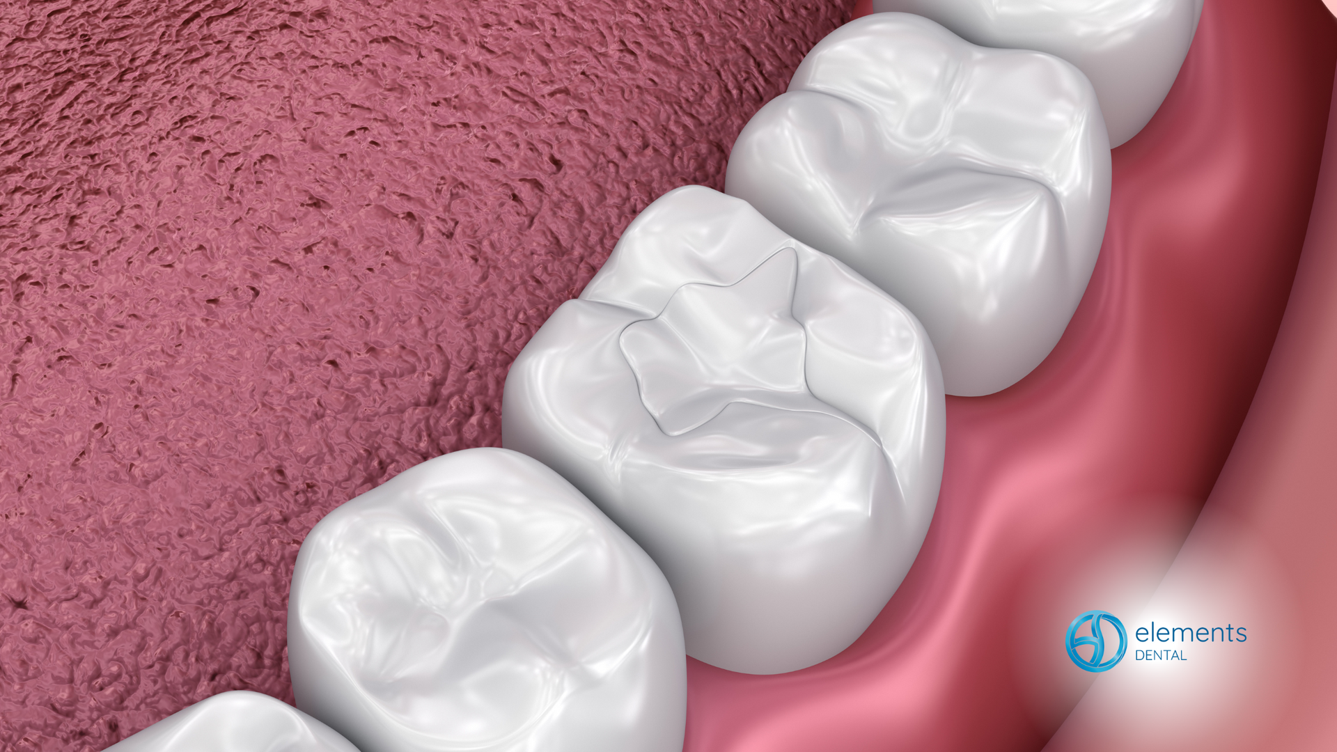 A computer generated image of a person 's teeth and gums.