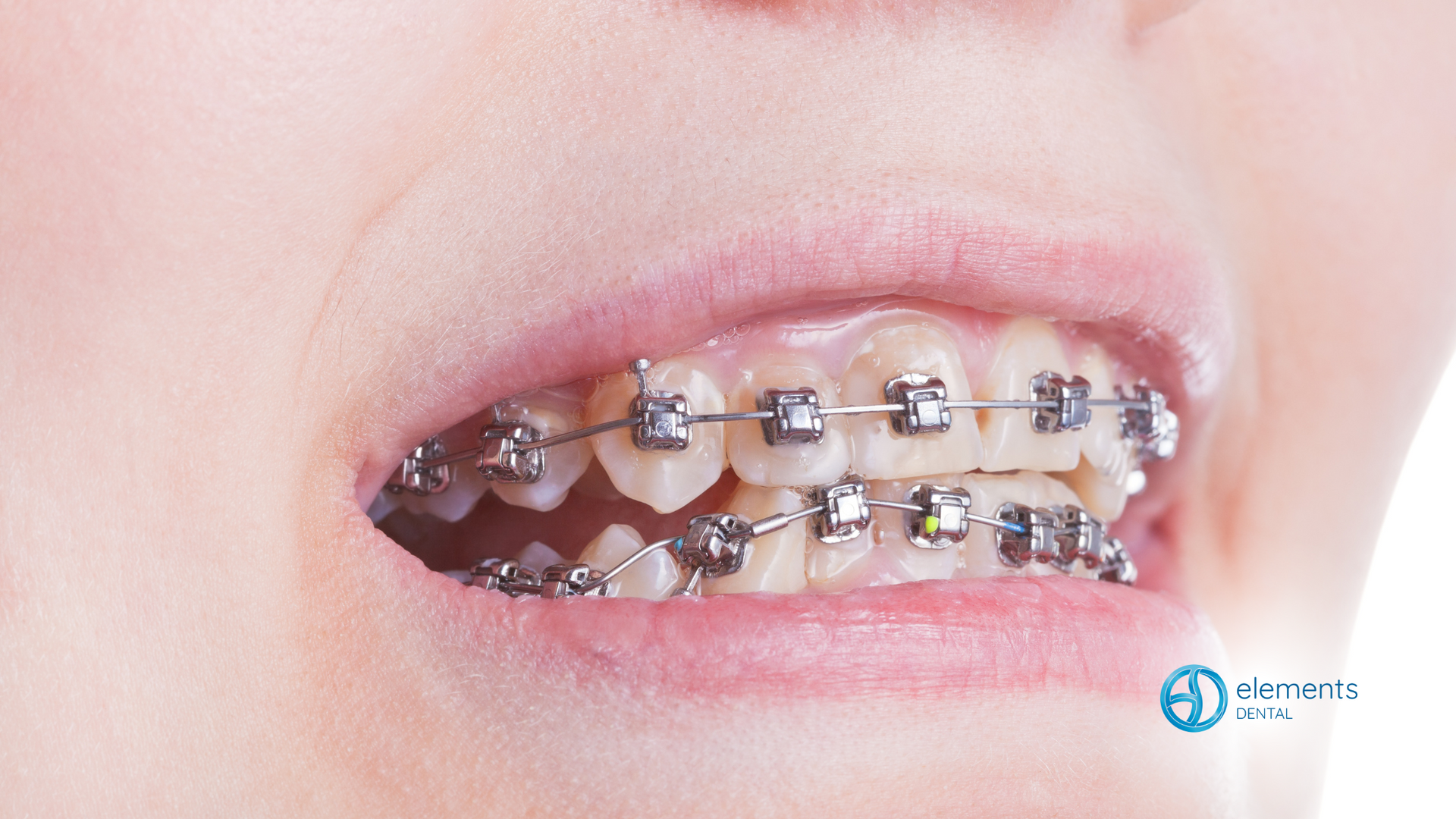 A close up of a person 's mouth with braces on their teeth.
