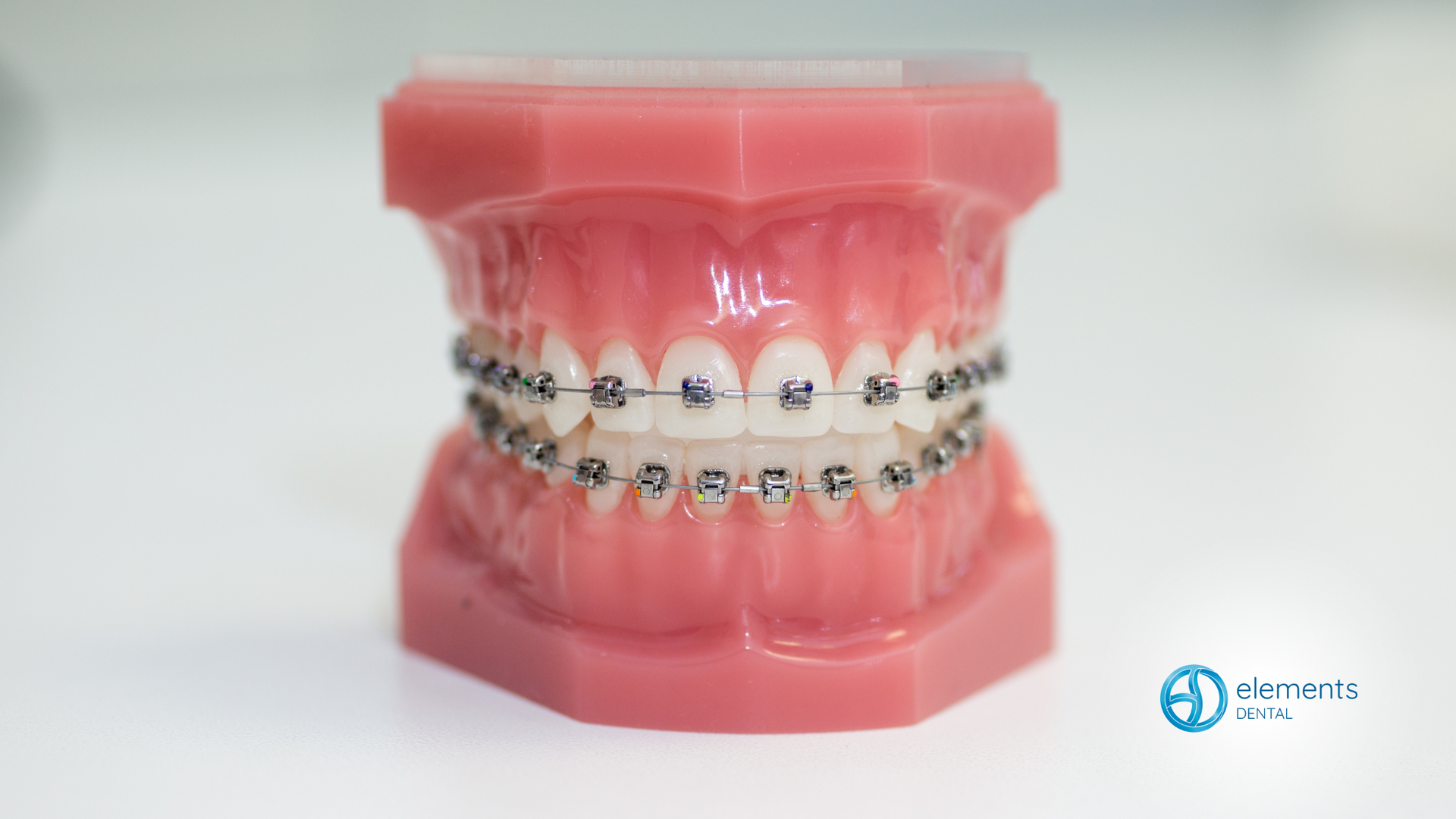 A model of a person 's teeth with braces on them.