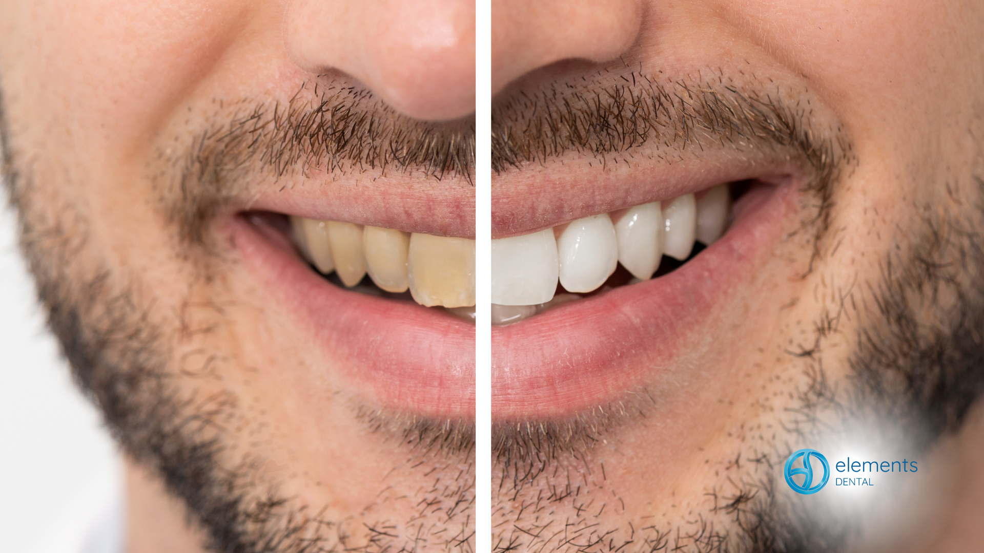 A man with a beard is shown before and after whitening his teeth.
