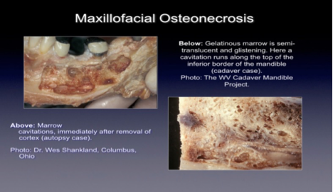 A picture of a bone with the words maxillofacial osteonecrosis on it