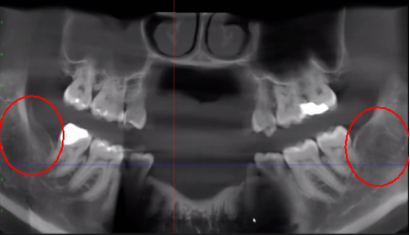 A black and white x-ray of a child 's teeth with red circles around the teeth.
