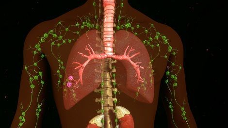 A computer generated image of a person 's lungs and lymphatic system.