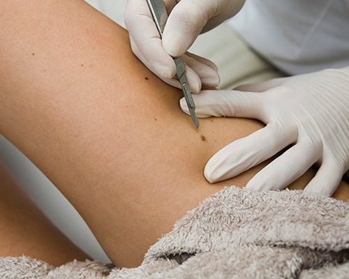 Removing Of Moles — Redlands, CA — Aesthetic Skin And Laser Removing Of Moles — Redlands, CA — Aesthetic Skin And Laser