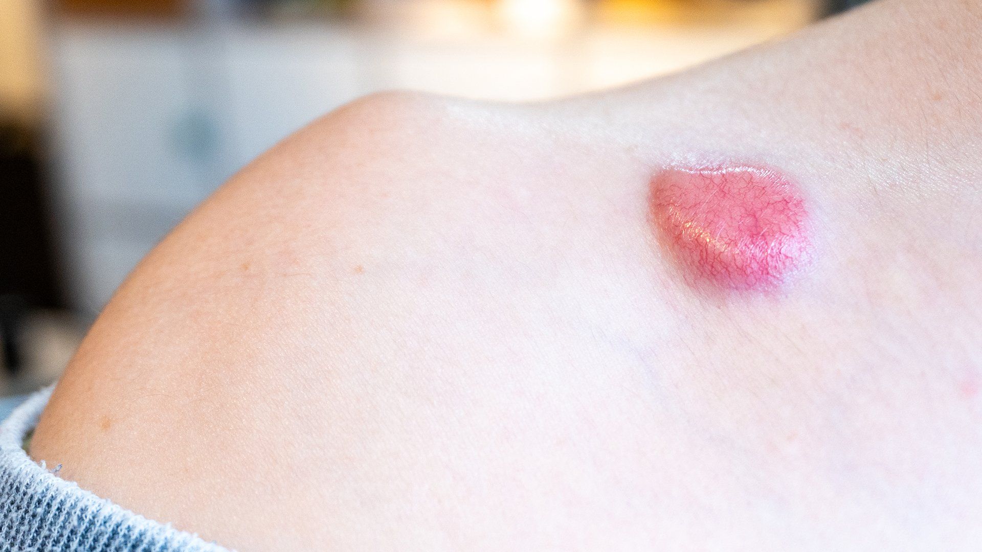 Mohs On Skin — Redlands, CA — Aesthetic Skin And Laser