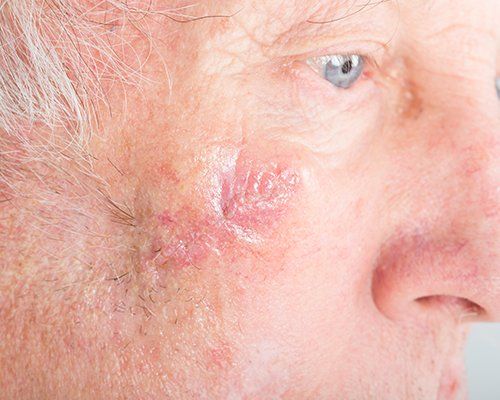 Mohs On Man Face — Redlands, CA — Aesthetic Skin And Laser Mohs On Man Face — Redlands, CA — Aesthetic Skin And Laser