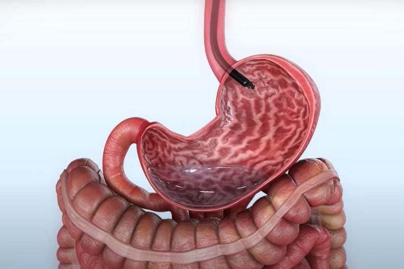 Gastroplastia Endoscópica em São Paulo - Obesicenter