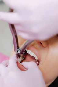 banana-river-dental-tooth-extractions-image