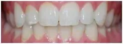Tooth Whitening After — Clinton, MD — Hamam & Lamb DDS PA