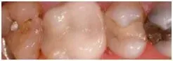 Porcelain Crowns After — Clinton, MD — Hamam & Lamb DDS PA