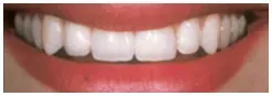 Implants After — Clinton, MD — Hamam & Lamb DDS PA