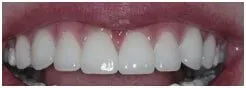 Porcelain Veneers After — Clinton, MD — Hamam & Lamb DDS PA