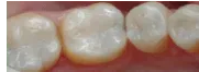 After White Fillings — Clinton, MD — Hamam & Lamb DDS PA