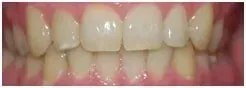 Tooth Whitening Before — Clinton, MD — Hamam & Lamb DDS PA