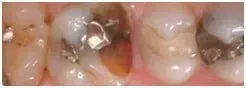 Porcelain Crowns Before — Clinton, MD — Hamam & Lamb DDS PA