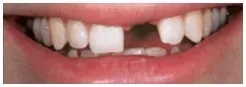 Implants Before — Clinton, MD — Hamam & Lamb DDS PA