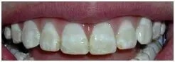 Porcelain Veneers Before — Clinton, MD — Hamam & Lamb DDS PA