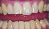 Before Teeth Whitening — Clinton, MD — Hamam & Lamb DDS PA