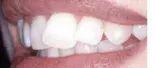 Before Veneers — Clinton, MD — Hamam & Lamb DDS PA