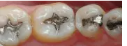 Before White Fillings — Clinton, MD — Hamam & Lamb DDS PA
