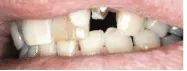 Before Crowns — Clinton, MD — Hamam & Lamb DDS PA