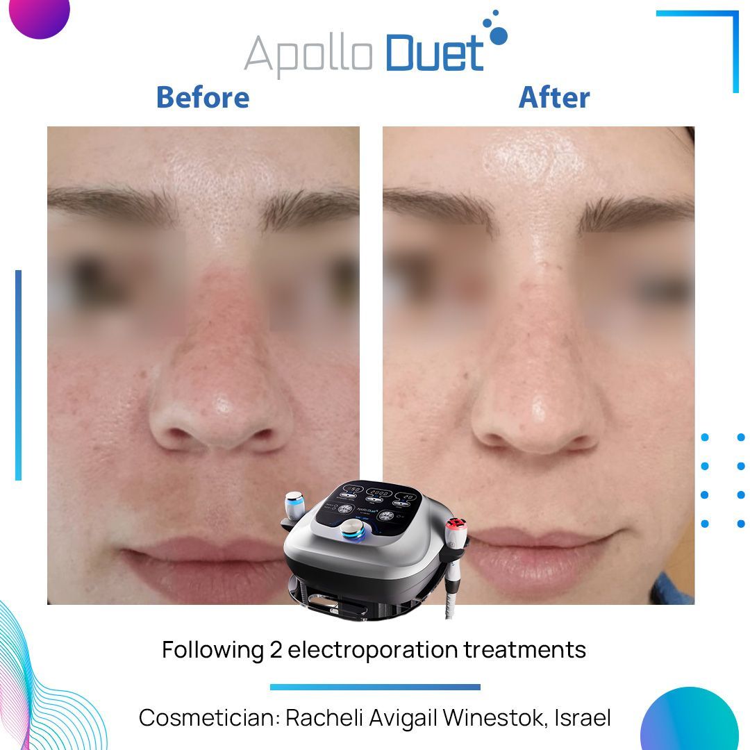 Apollo Duet-Werbung mit Vorher-Nachher-Bildern zur Verbesserung des Gesichtshautbildes durch ein Behandlungsgerät (siehe unten)