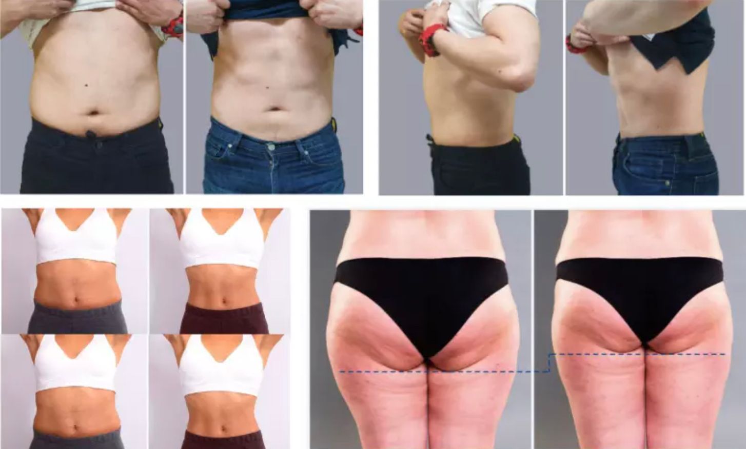 Vorher-Nachher-Fotos von Oberkörper und Taille zeigen Gewichtsverlust und schlankere Figur in Jeans und Unterwäsche.