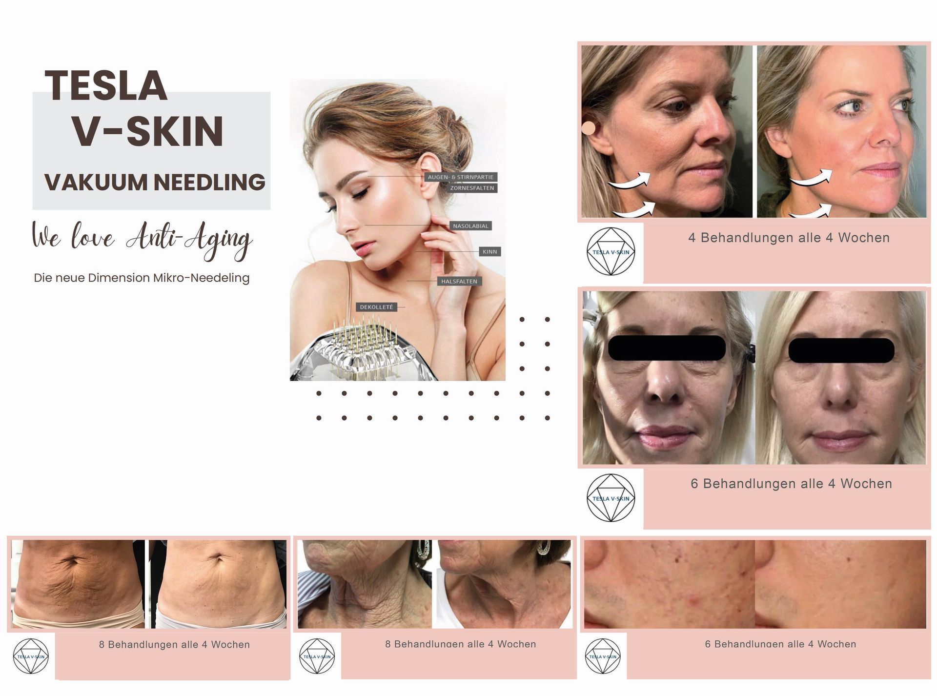 Werbung für Tesla V-Skin Vakuum-Microneedling mit Vorher-Nachher-Fotos und Produktbildern zur Gesichtsbehandlung.