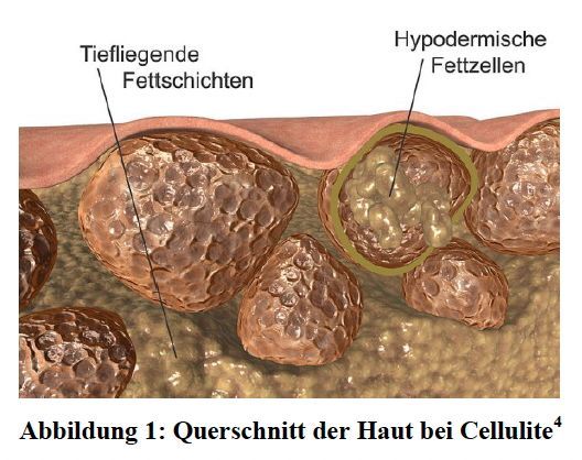 Querschnitt der Haut bei Cellulite mit tief liegenden Fettschichten und hypodermischen Fettzellen