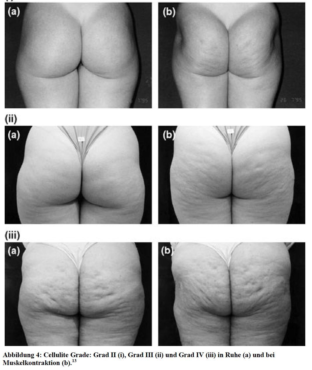 Dreiteilige Vergleichsdarstellung von Gesäßfotos, gekennzeichnet mit a und b, die unterschiedliche Hautstruktur und -form zeigen.