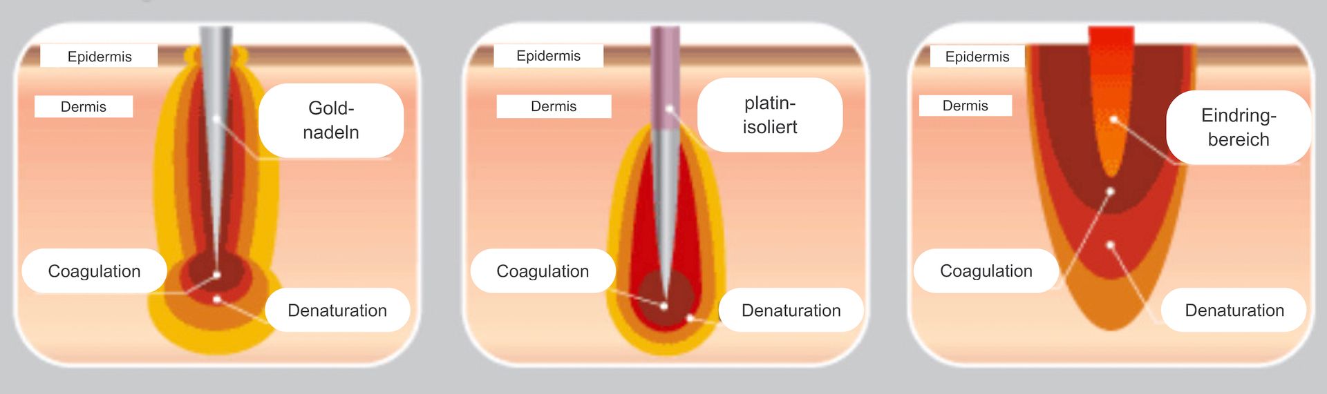 Dreiteiliges Diagramm einer Zahnfüllungskavität mit orangefarbenem Zahnfleisch und weißen Beschriftungen, die die Behandlungsschritte zeigen.