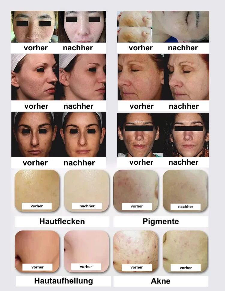 Ein Vorher-Nachher-Bild des Gesichts einer Frau
