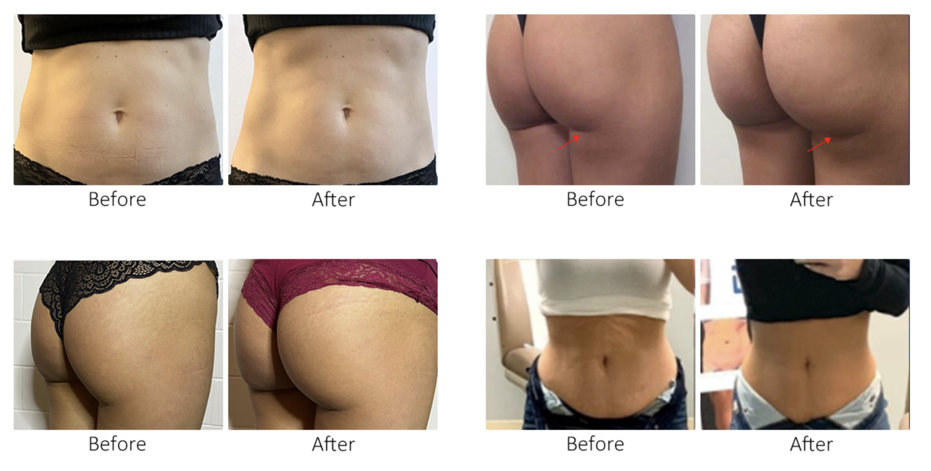 Tesla Shape Optima Vorher-Nachher-Collage der Ergebnisse einer Körperformung, die Rücken, Oberschenkel und Taille in Unterwäsche zeigt.