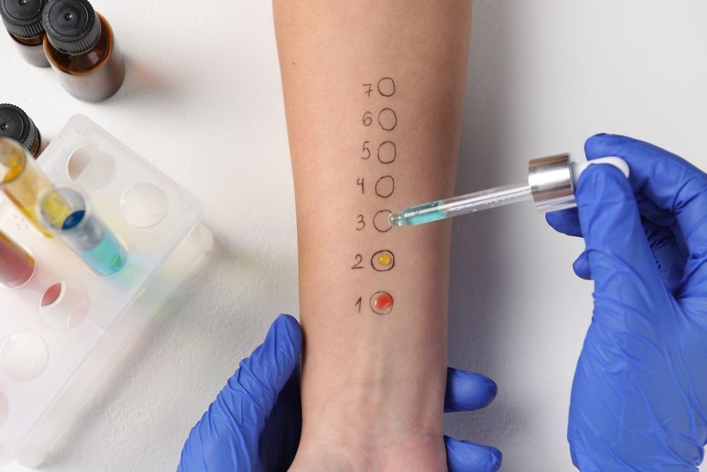 A person is getting an allergy test on their arm.