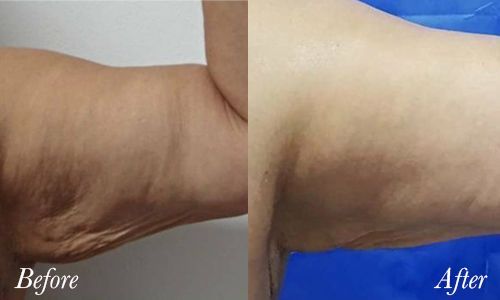 Fotona T Runner huidverslapping armen Fotona T-Runner aangeboden in de Haar en Huid Kliniek in Tessenderlo voor België en Nederland