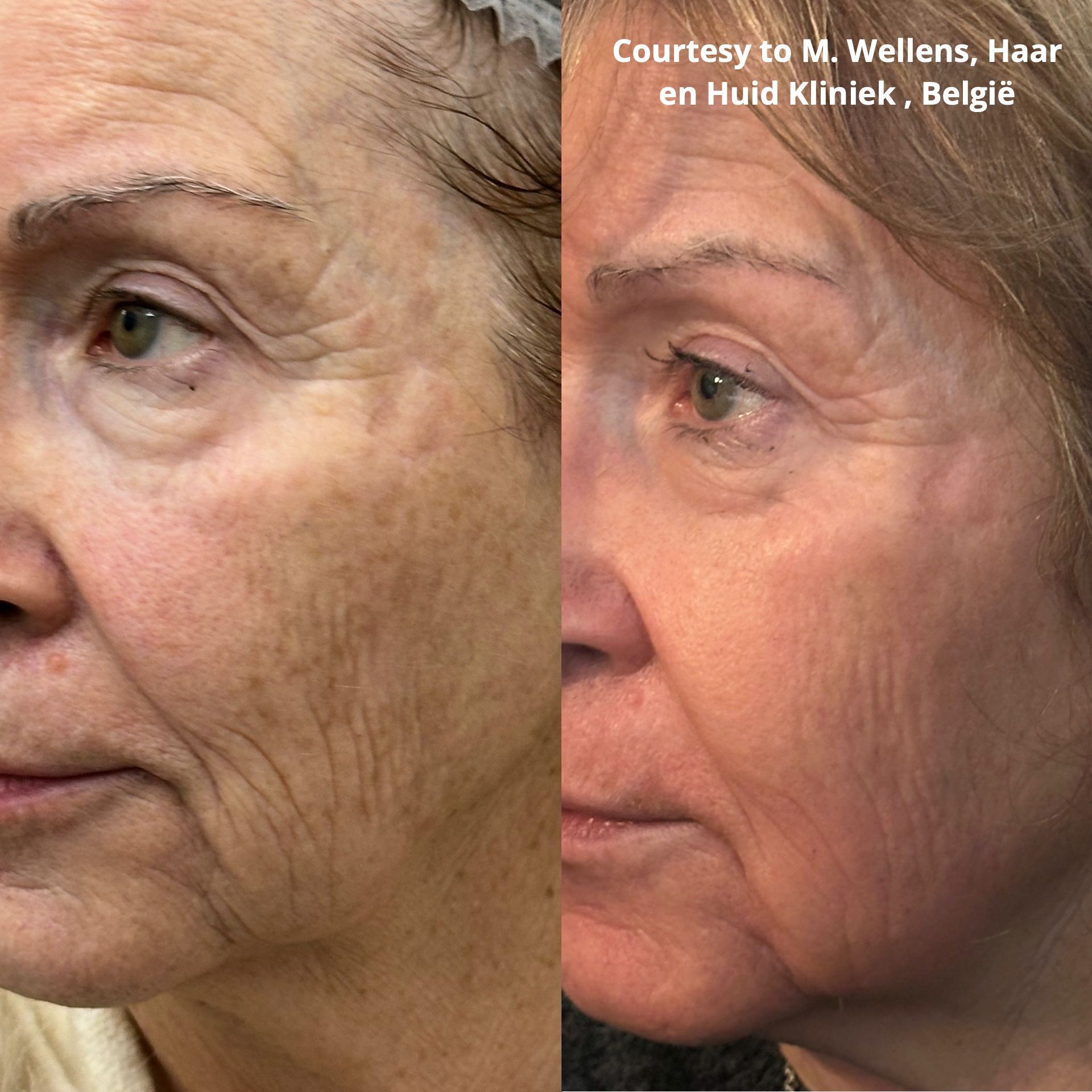 Fotona fractionele resurfacing haar en huid kliniek Tessenderlo laserpeeling huidherstel huidverjonging voor België en Nederland