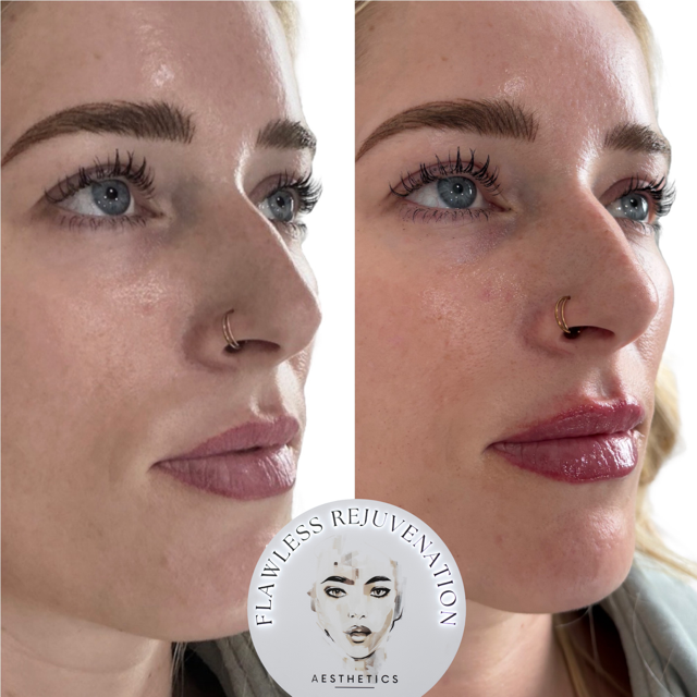 Side-by-side close-up profile of a woman before and after lip enhancement, with glossy fuller lips on the right.