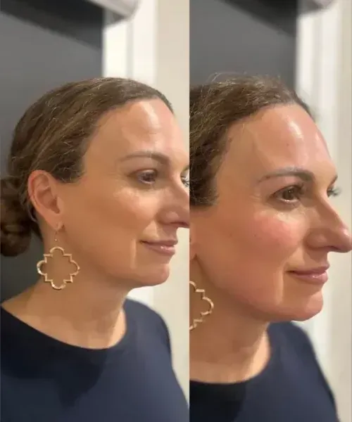 Side-by-side profile photos of a person indoors, before and after facial skin treatment.