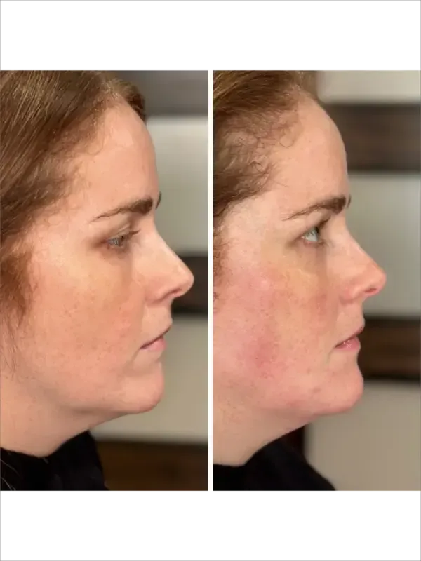 Side-by-side profile photos of a woman’s face, showing before and after appearance