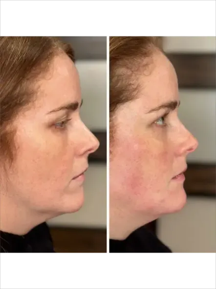 Side-by-side profile photos of a woman’s face, showing before and after appearance