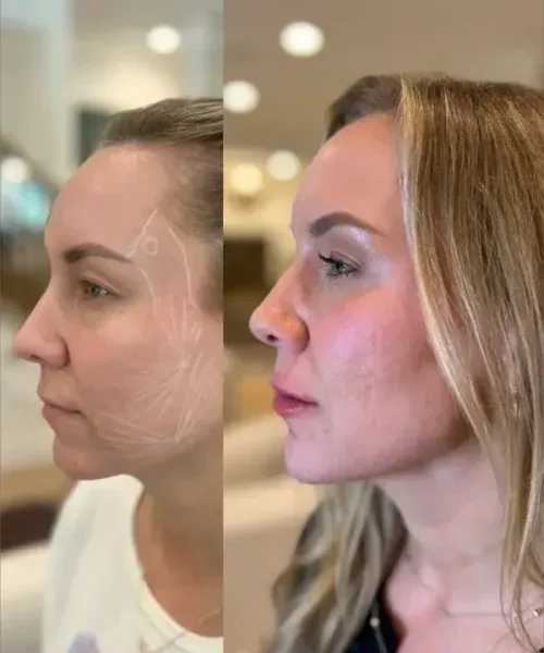 Side-by-side profile view of a woman’s face before and after cosmetic treatment, indoors