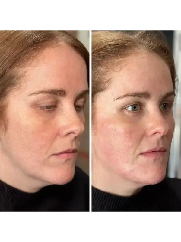 Side-by-side profile photos of the same woman, showing a subtle facial change before and after treatment.