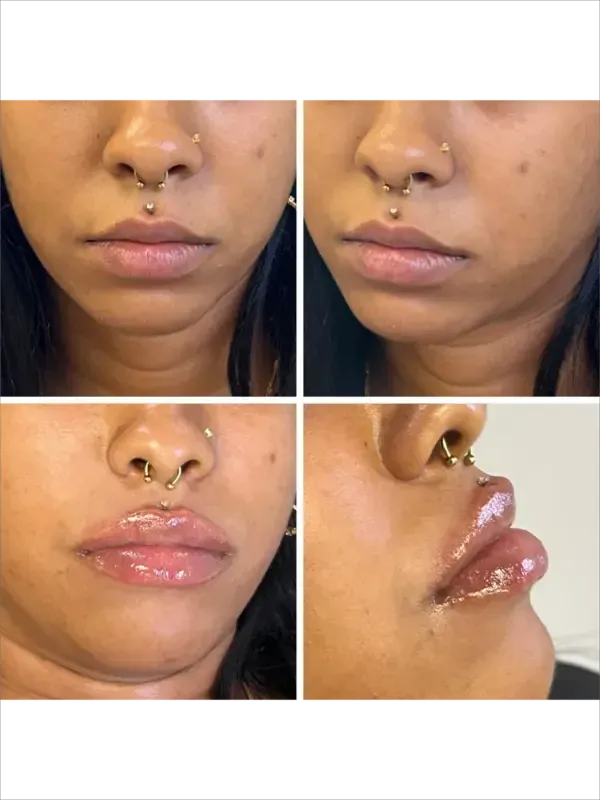Close-up medical photos of a nose and upper lip with a septum ring and glossy lip product